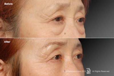 Eyelift Before & After Gallery - Patient 106009277 - Image 1