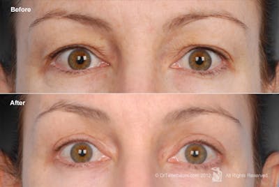 Eyelift Before & After Gallery - Patient 106009278 - Image 1