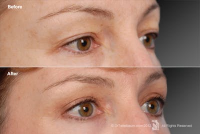 Eyelift Before & After Gallery - Patient 106009279 - Image 1