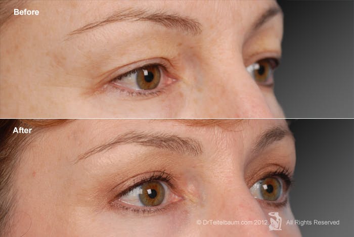 Eyelift Before & After Gallery - Patient 106009279 - Image 1