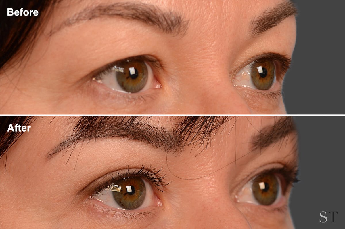 Eyelift Before & After Gallery - Patient 106009280 - Image 1
