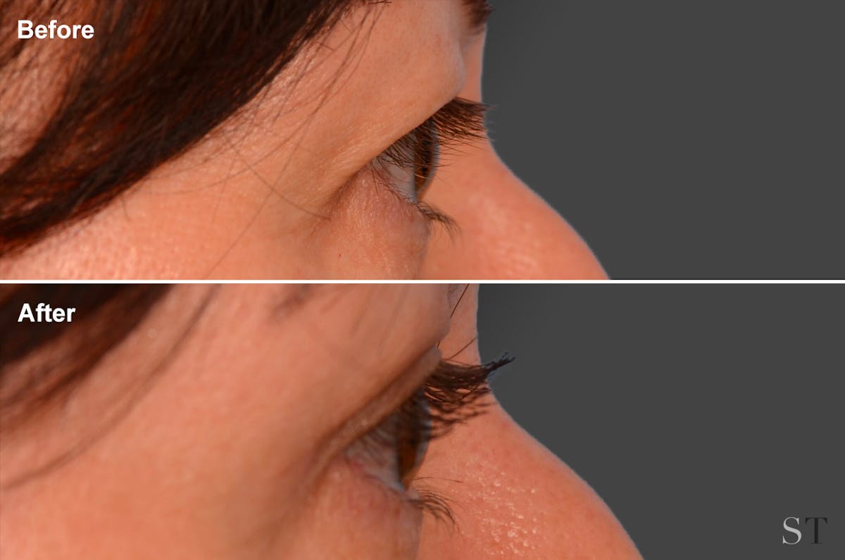 Eyelift Before & After Gallery - Patient 106009281 - Image 1