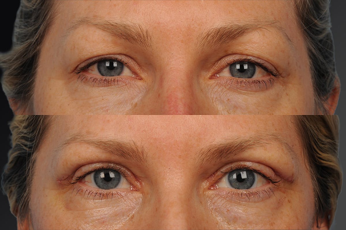 Eyelift Before & After Gallery - Patient 106009282 - Image 1