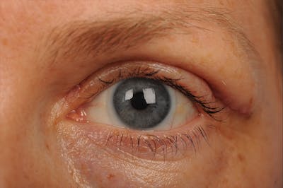 Eyelift Before & After Gallery - Patient 106009283 - Image 1
