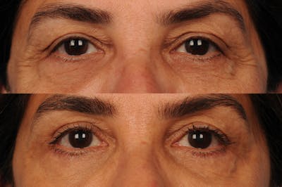 Eyelift Before & After Gallery - Patient 106009284 - Image 1