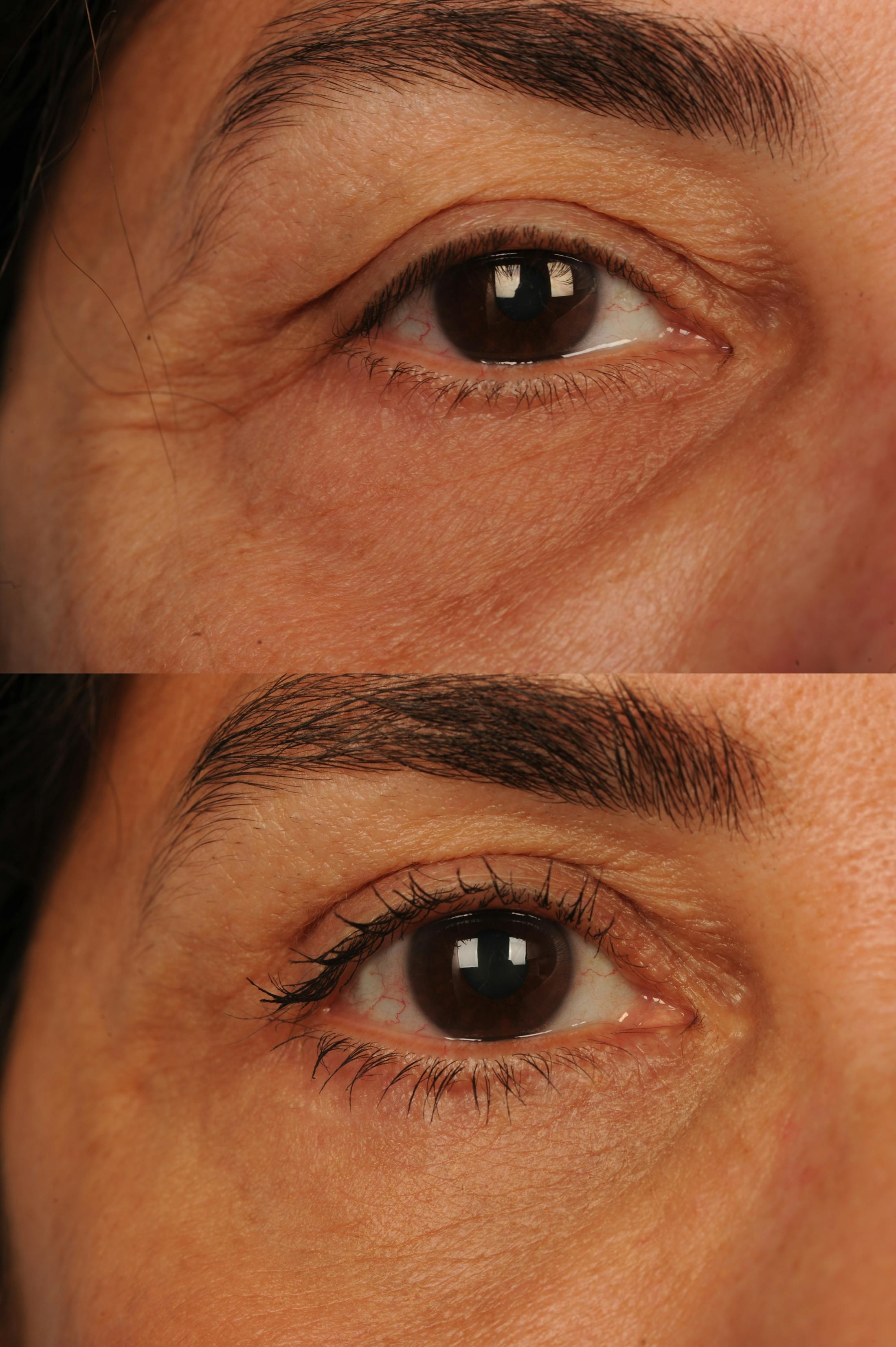 Eyelift Before & After Gallery - Patient 106009285 - Image 1