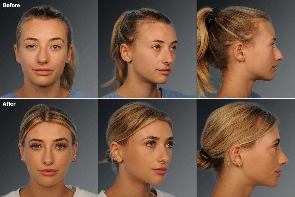 Rhinoplasty Before & After Gallery - Patient 106009290 - Image 1