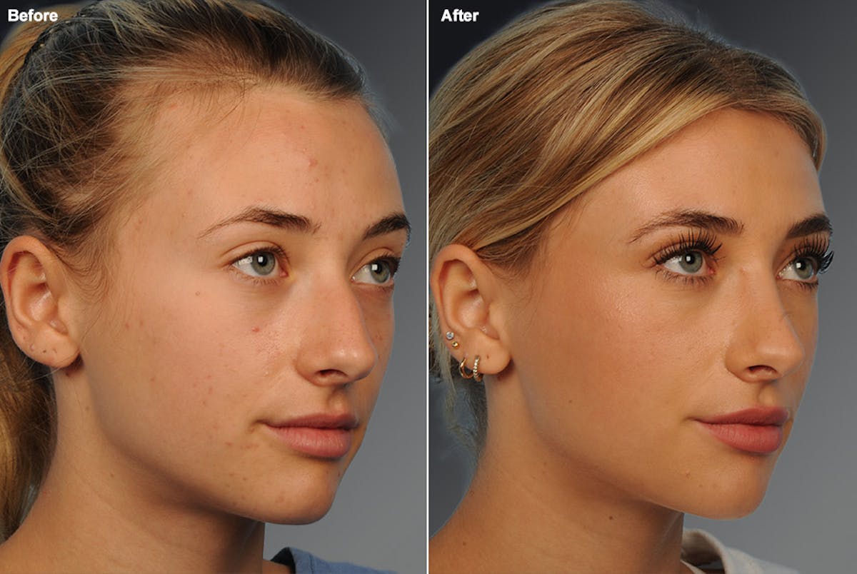 Rhinoplasty Before & After Gallery - Patient 106009291 - Image 1