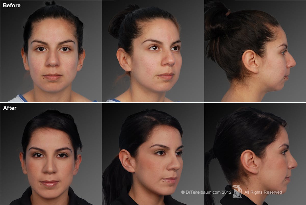 Rhinoplasty Before & After Gallery - Patient 106009292 - Image 1