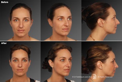 Rhinoplasty Before & After Gallery - Patient 106009293 - Image 1