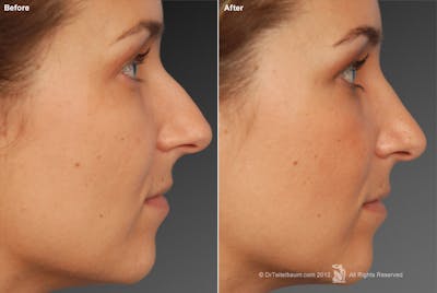 Rhinoplasty Before & After Gallery - Patient 106009294 - Image 1