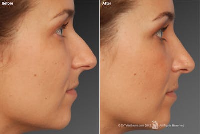 Rhinoplasty Before & After Gallery - Patient 106009294 - Image 1
