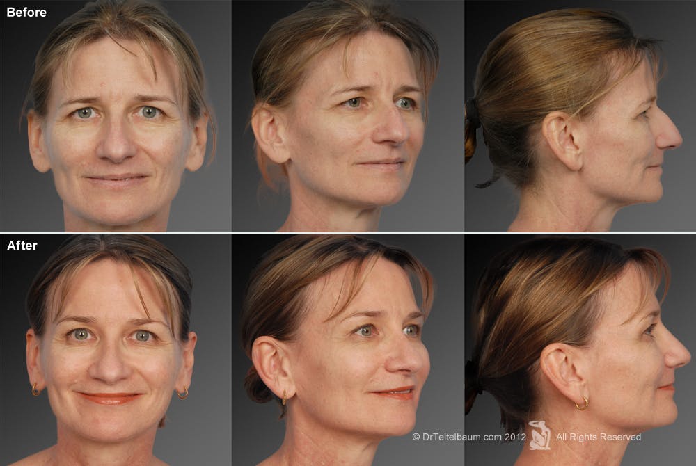Rhinoplasty Before & After Gallery - Patient 106009295 - Image 1