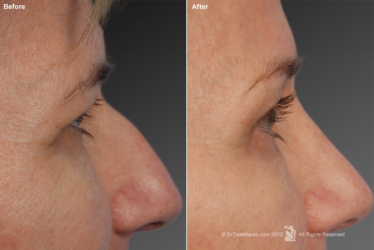 Rhinoplasty Before & After Gallery - Patient 106009296 - Image 1