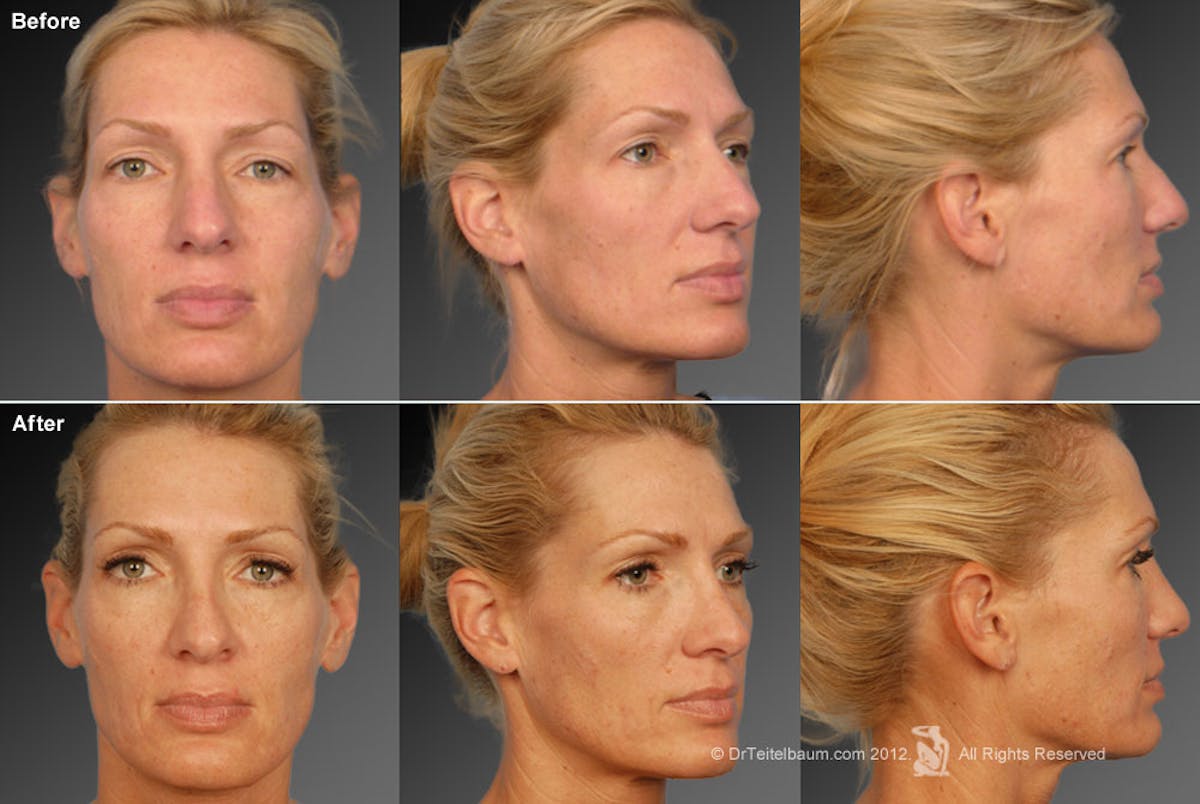 Rhinoplasty Before & After Gallery - Patient 106009297 - Image 1