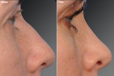 Rhinoplasty Before & After Gallery - Patient 106009298 - Image 1