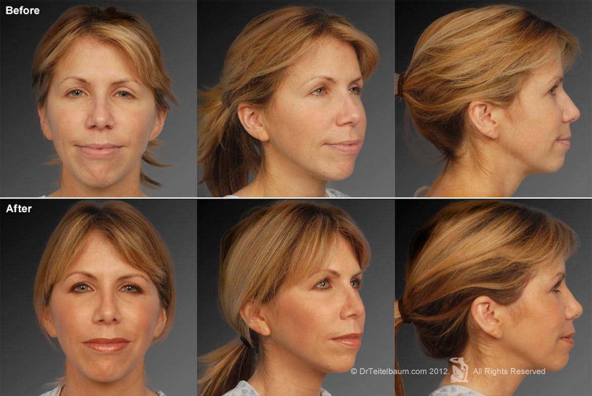 Rhinoplasty Before & After Gallery - Patient 106009299 - Image 1