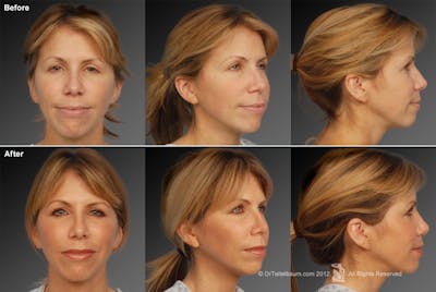 Rhinoplasty Before & After Gallery - Patient 106009299 - Image 1