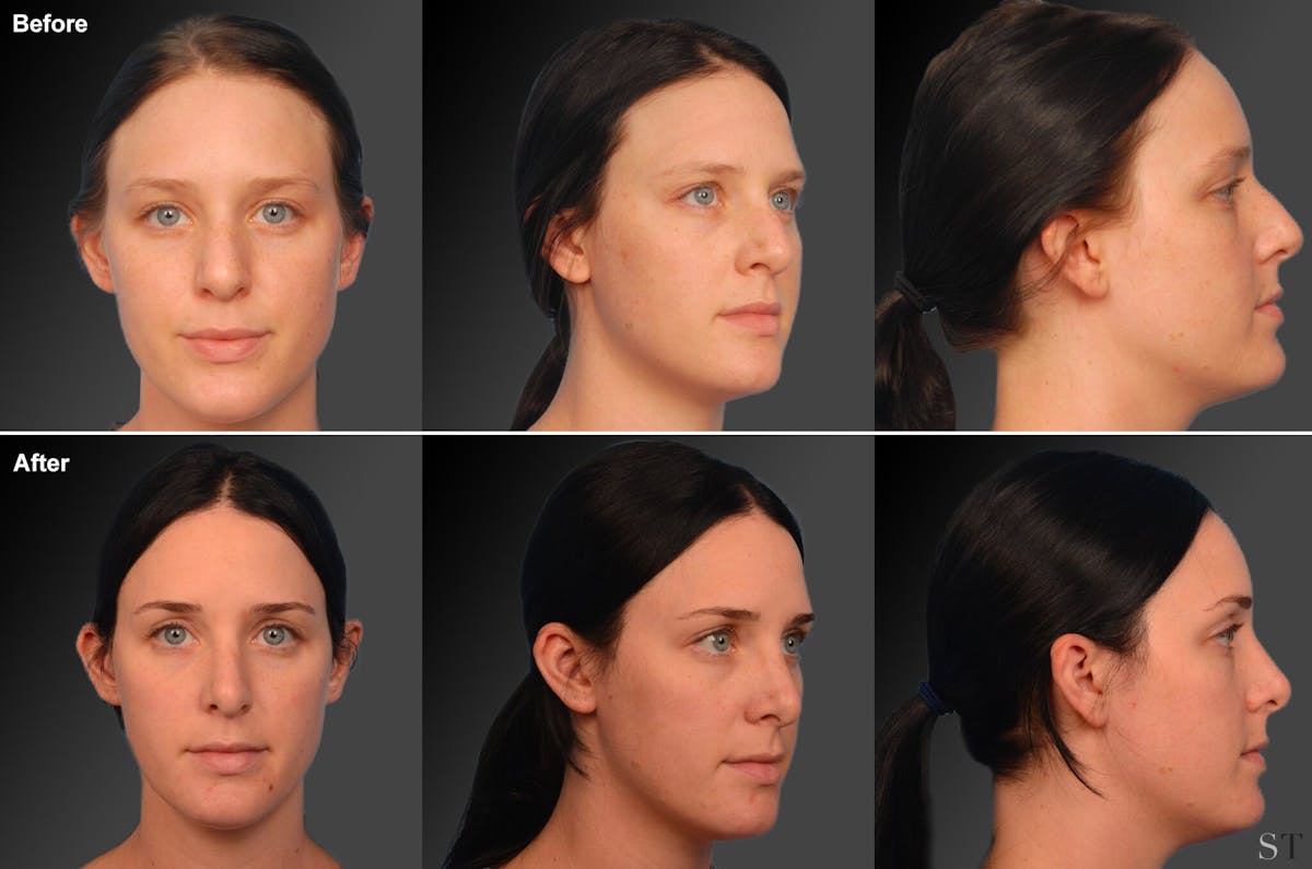 Rhinoplasty Before & After Gallery - Patient 106009300 - Image 1