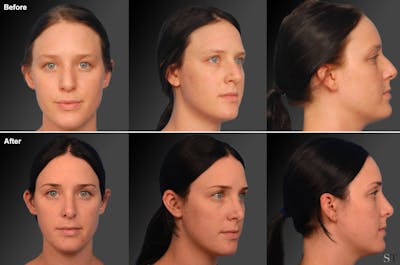 Rhinoplasty Before & After Gallery - Patient 106009300 - Image 1