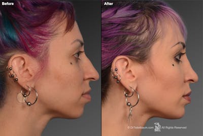 Rhinoplasty Before & After Gallery - Patient 106009301 - Image 1