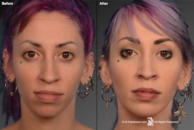 Rhinoplasty Before & After Gallery - Patient 106009302 - Image 1