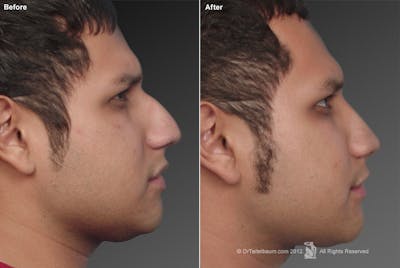 Rhinoplasty Before & After Gallery - Patient 106009305 - Image 1