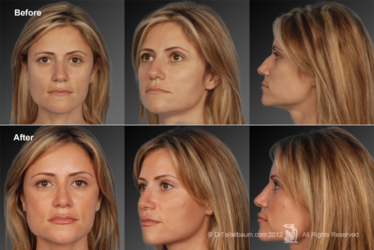 Rhinoplasty Before & After Gallery - Patient 106009306 - Image 1