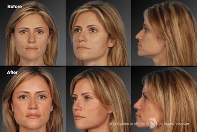 Rhinoplasty Before & After Gallery - Patient 106009306 - Image 1
