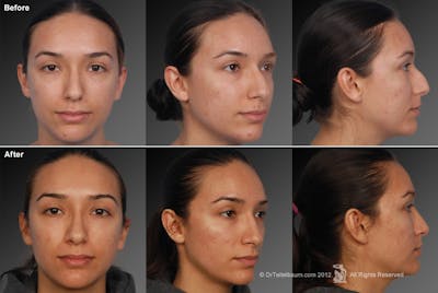 Rhinoplasty Before & After Gallery - Patient 106009307 - Image 1