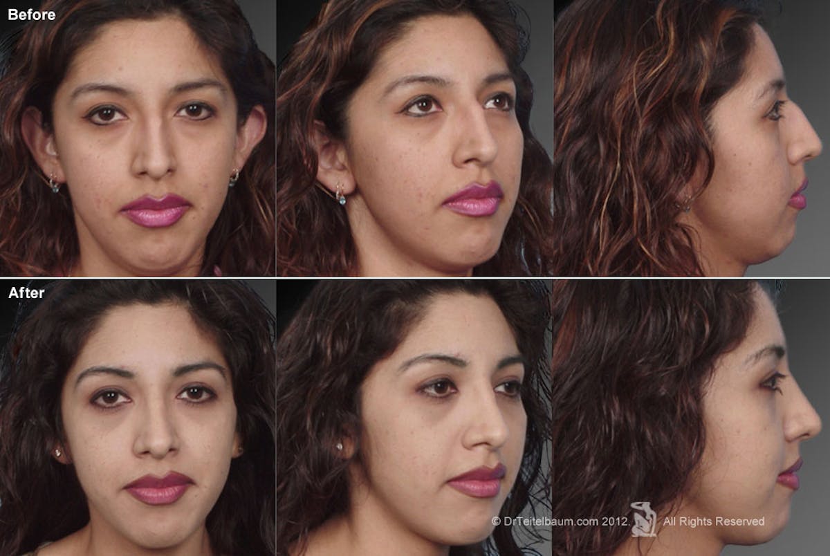 Rhinoplasty Before & After Gallery - Patient 106009308 - Image 1