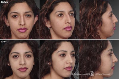 Rhinoplasty Before & After Gallery - Patient 106009308 - Image 1