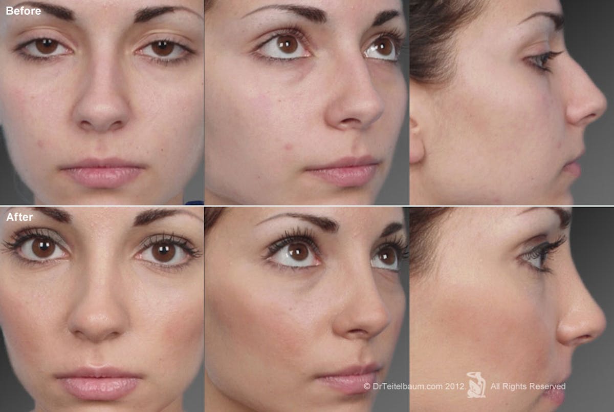 Rhinoplasty Before & After Gallery - Patient 106009310 - Image 1