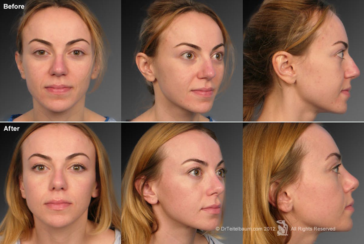 Rhinoplasty Before & After Gallery - Patient 106009312 - Image 1