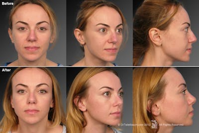 Rhinoplasty Before & After Gallery - Patient 106009312 - Image 1