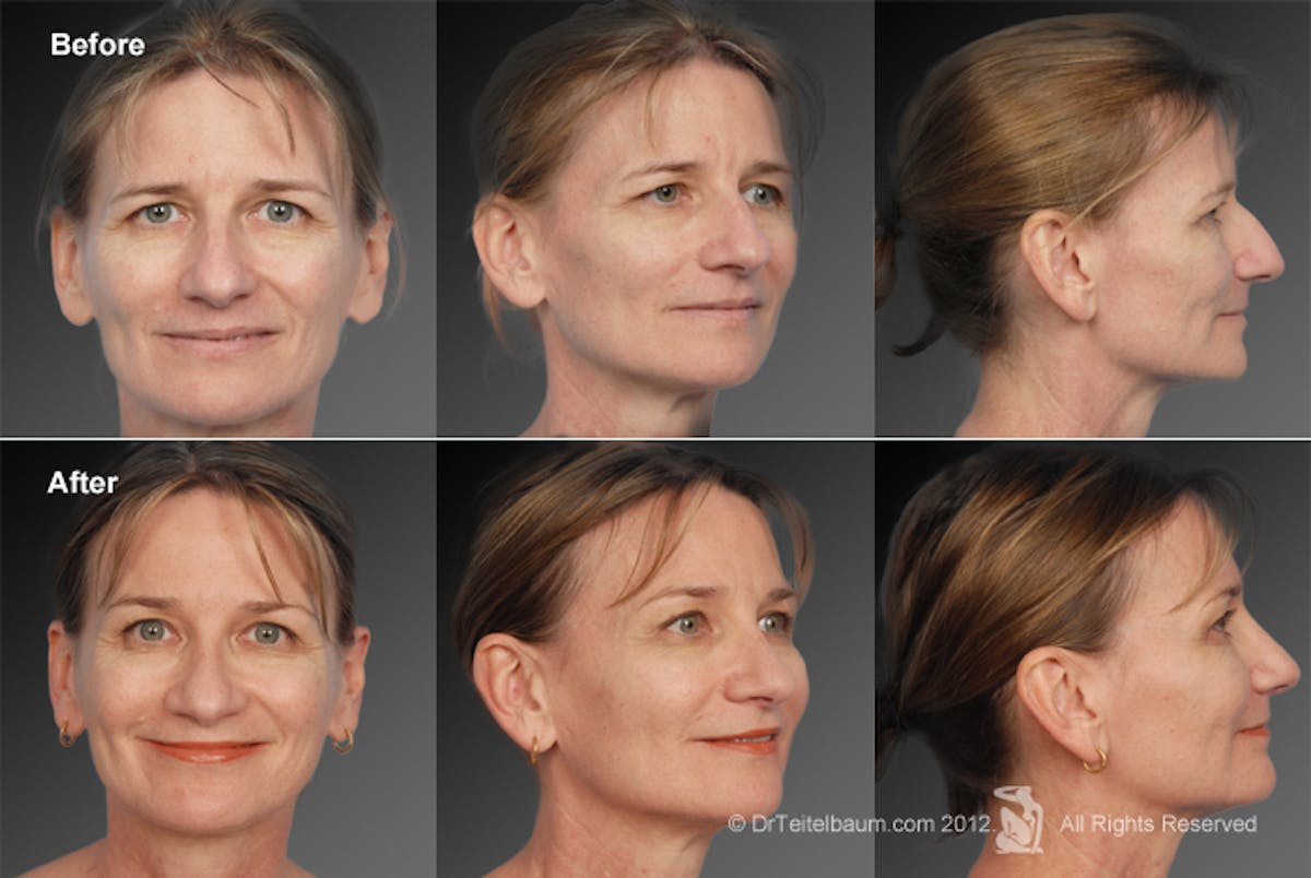 Brow Lift Before & After Gallery - Patient 106009321 - Image 1