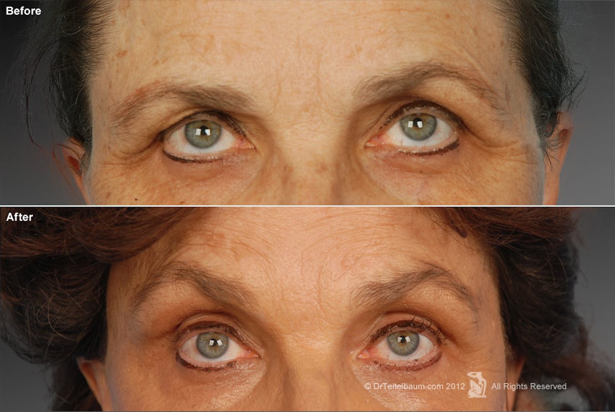 Brow Lift Before & After Gallery - Patient 106009322 - Image 1