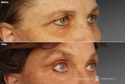 Brow Lift Before & After Gallery - Patient 106009324 - Image 1