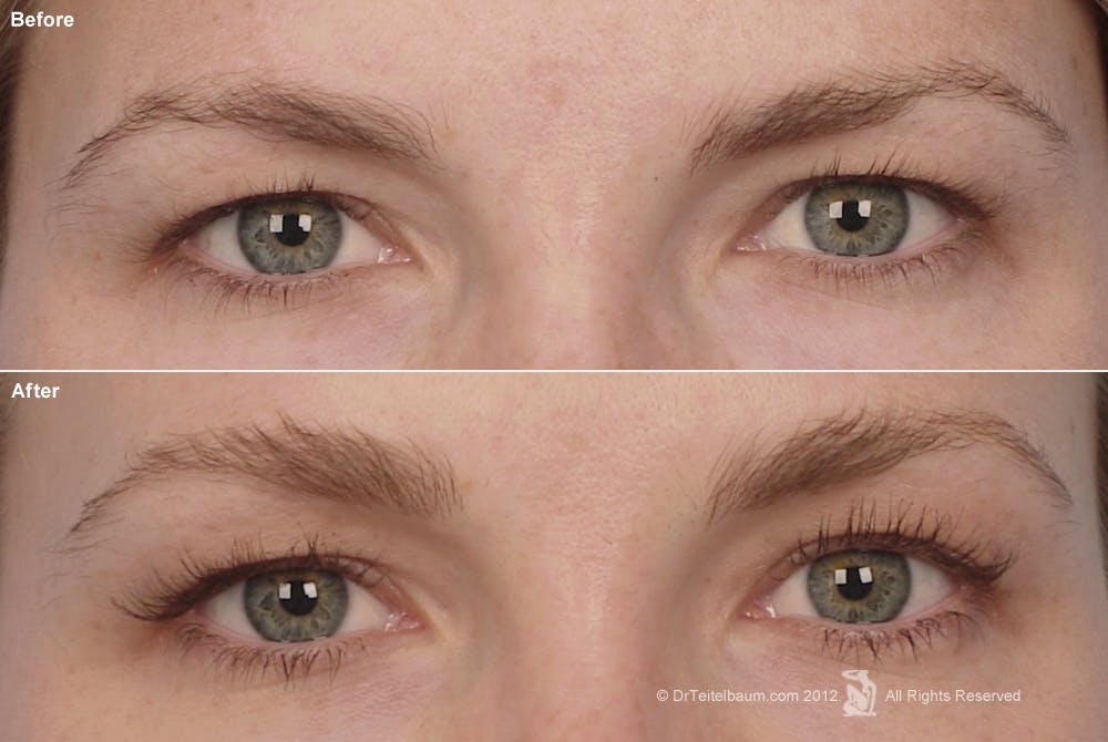 Brow Lift Before & After Gallery - Patient 106009325 - Image 1