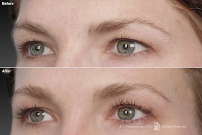 Brow Lift Before & After Gallery - Patient 106009326 - Image 1
