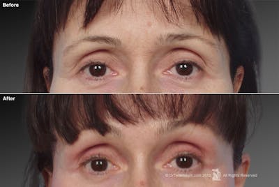 Brow Lift Before & After Gallery - Patient 106009327 - Image 1