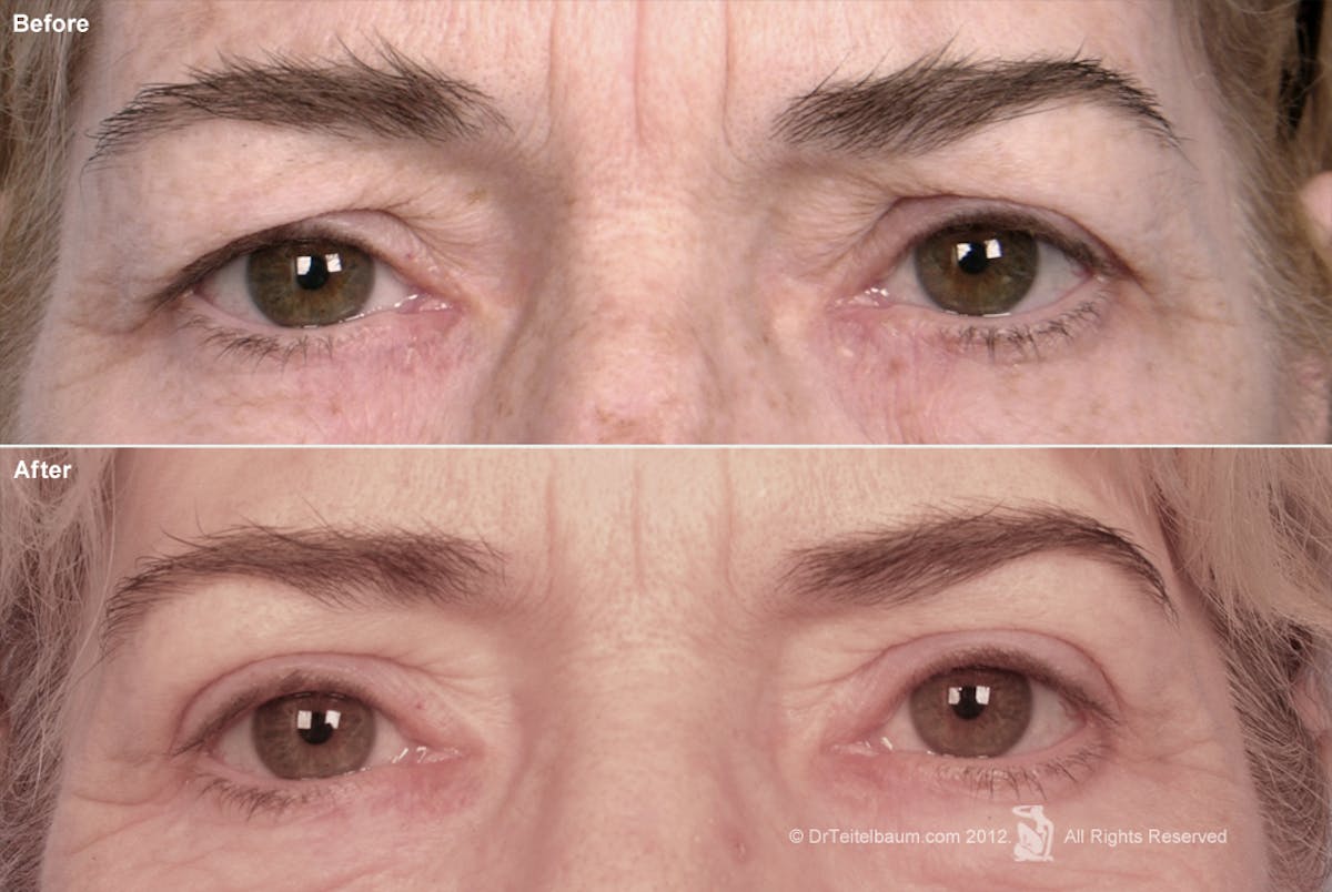 Eyelift Before & After Gallery - Patient 194149 - Image 1