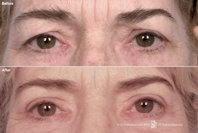 Brow Lift Before & After Gallery - Patient 106009328 - Image 1