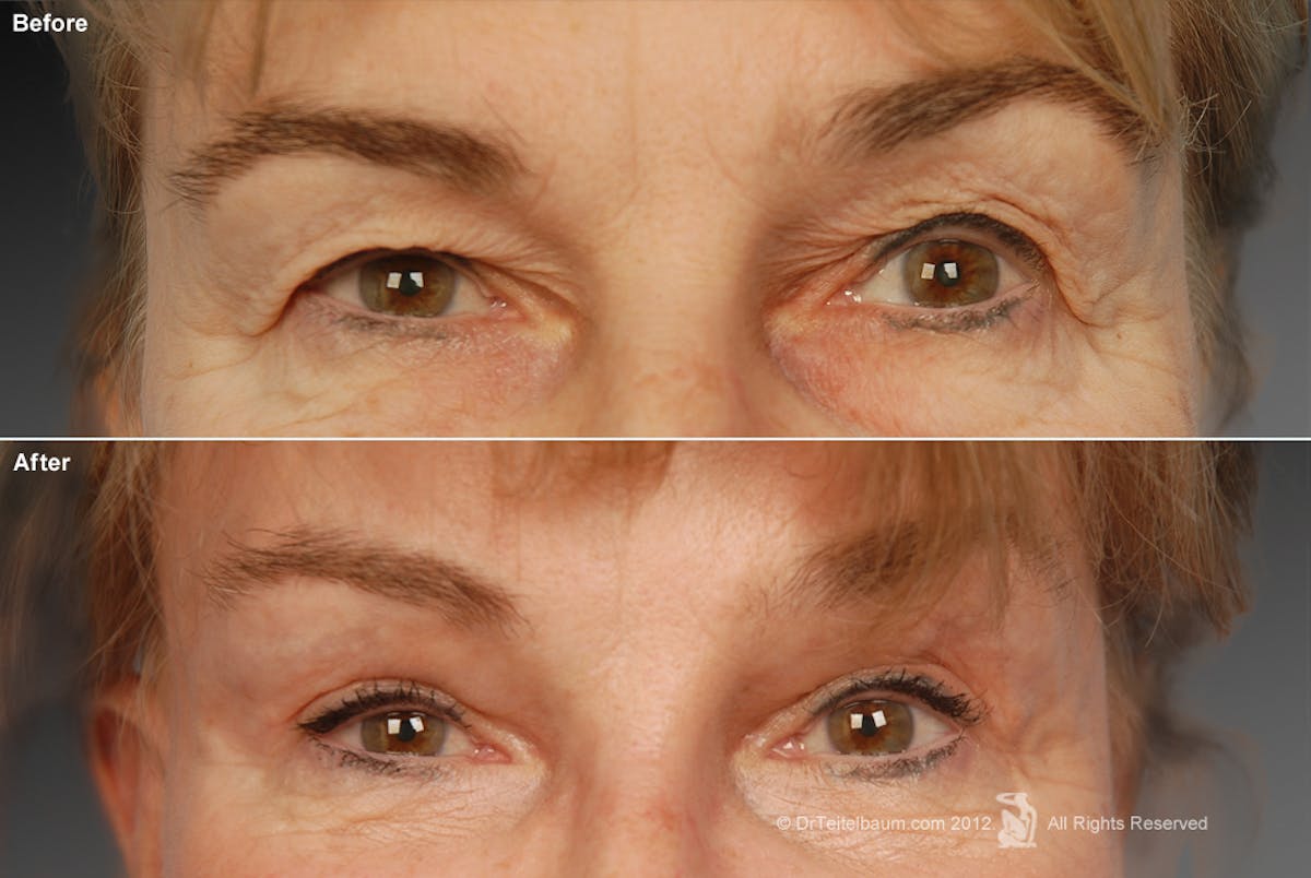 Brow Lift Before & After Gallery - Patient 106009329 - Image 1