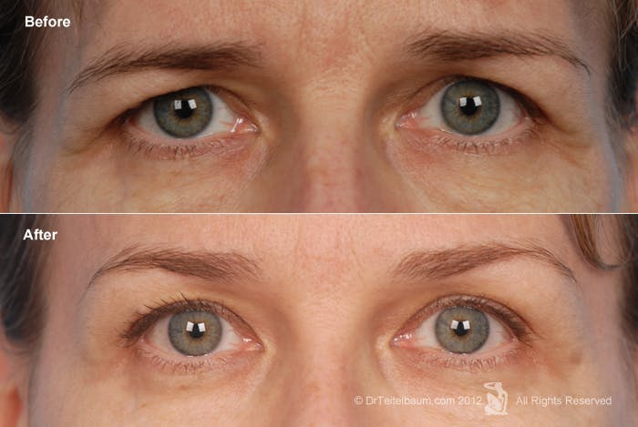 Brow Lift Before & After Gallery - Patient 106009330 - Image 1