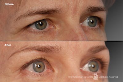 Brow Lift Before & After Gallery - Patient 106009332 - Image 1