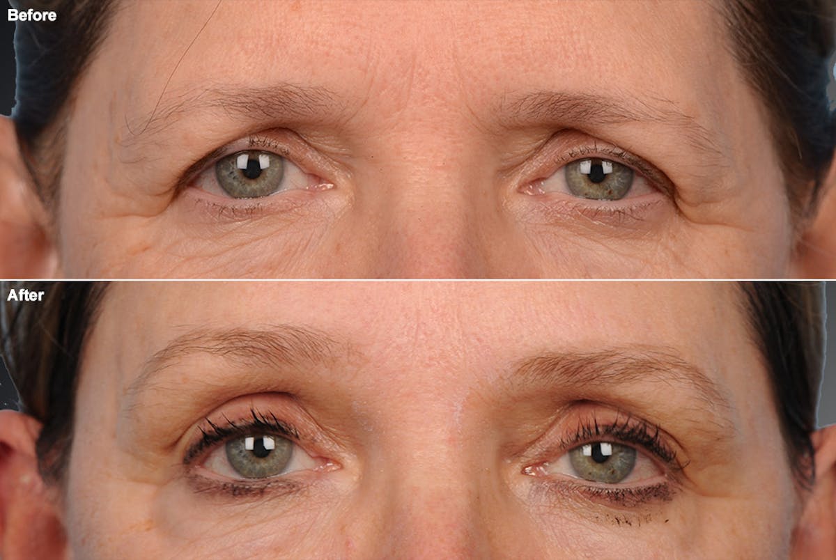 Brow Lift Before & After Gallery - Patient 106009333 - Image 1