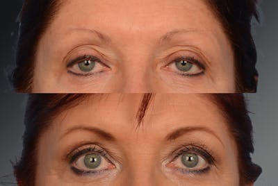 Brow Lift Before & After Gallery - Patient 106009334 - Image 1
