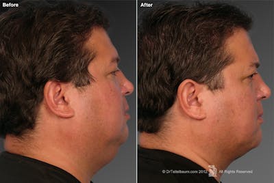Chin Augmentation Before & After Gallery - Patient 106009394 - Image 1