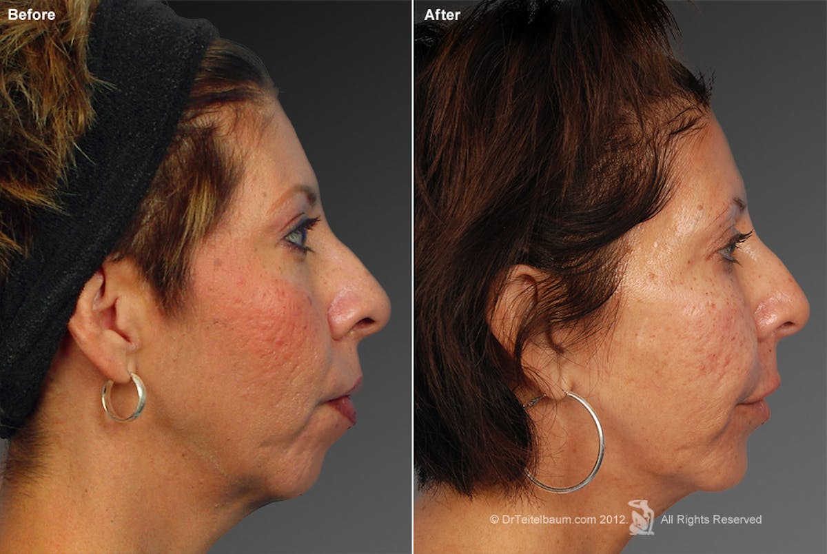Chin Augmentation Before & After Gallery - Patient 106009395 - Image 1